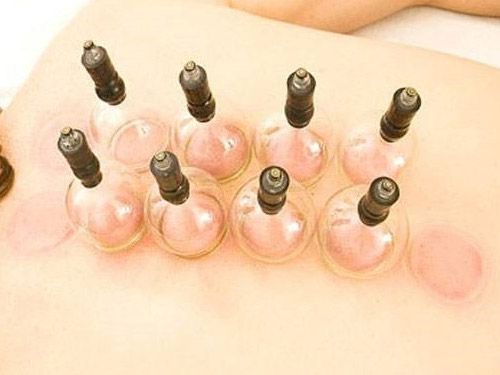 拔罐減肥的好處和壞處