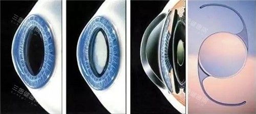 白內(nèi)障晶體手術(shù)細(xì)節(jié)圖