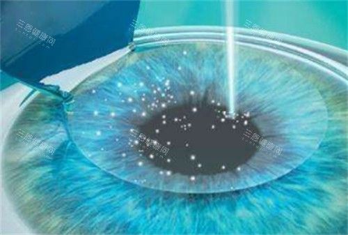 綠飛秒近視手術(shù)過程圖解