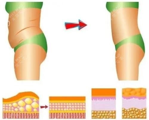 吸脂過程前后示意圖