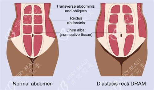 腹壁成形改善肌肉