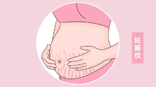 對妊娠紋有效的產(chǎn)品