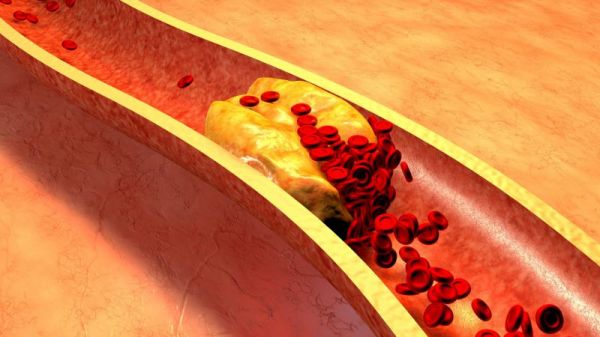 低密度膽固醇低怎么治療