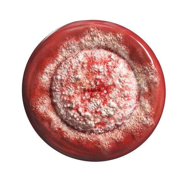 頸椎有富貴包怎么去除 烏海富貴包抽脂手術(shù)有風(fēng)險嗎