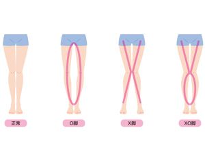 嬰兒學步期，怎樣預防腿部健康成長？