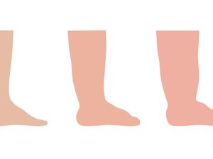 嬰兒學步期，怎樣預防腿部健康成長？