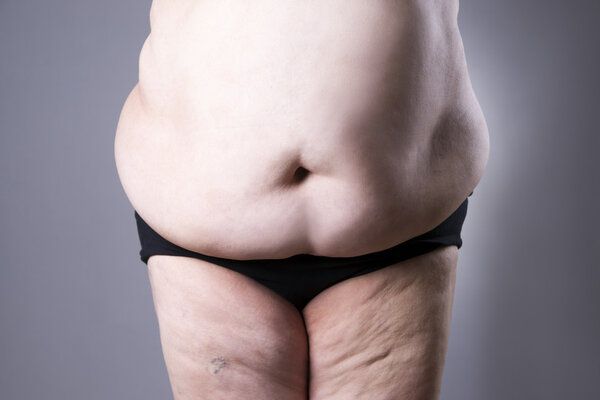 產(chǎn)后肥胖水腫怎么消除