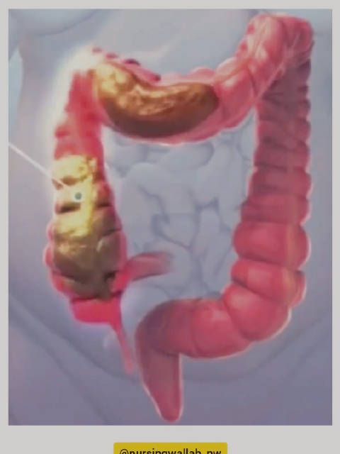 糞便在大腸中的走形方向，從右下腹往上（升結(jié)腸）……