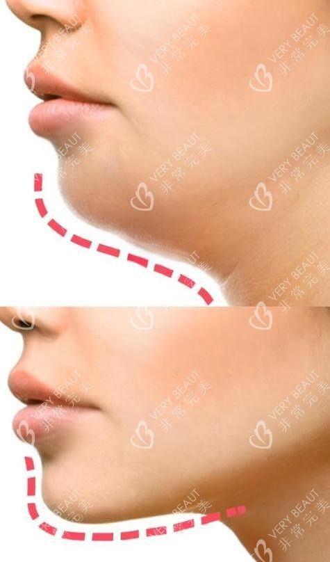雙下巴抽脂前后對比側面圖