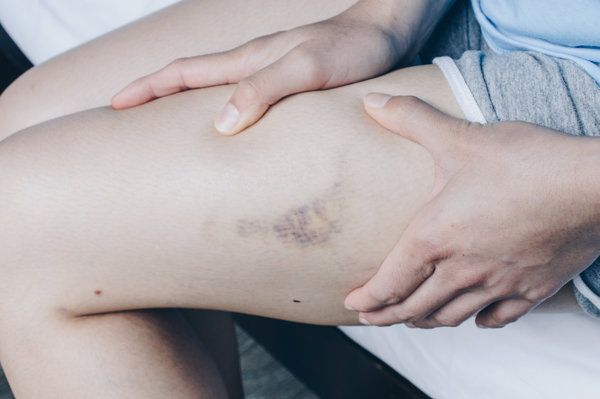 剖腹产刀口上下有淤青正常吗