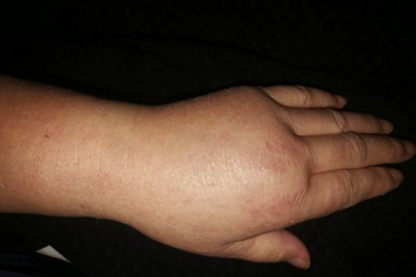 获得性血管性水肿手部症状图