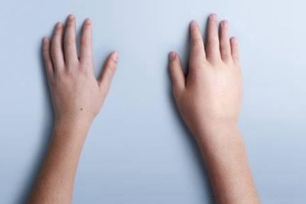 获得性血管性水肿手部水肿图