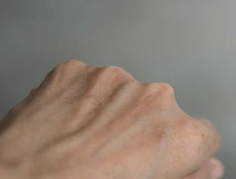 薄皮肤：形成的原因及注意事项插图