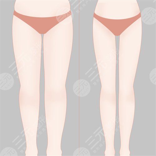 吸脂減肥整形手術(shù)之后