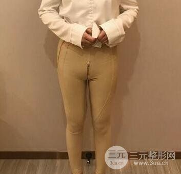 小腿吸脂案例反饋術(shù)后3天