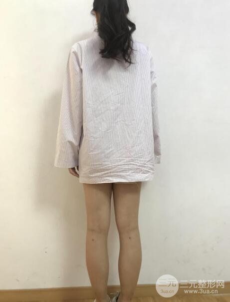 小腿吸脂案例反饋術(shù)前