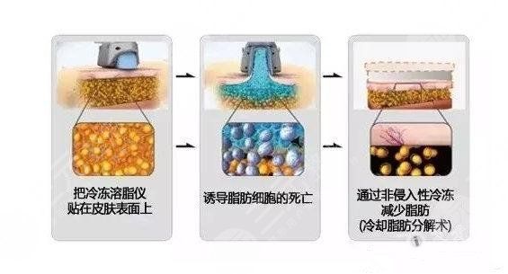 酷塑冷凍減脂副作用