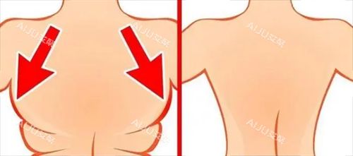 背部吸脂前后动画对比图