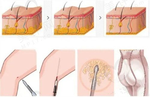 燃脂炮【&nbsp;】好吗