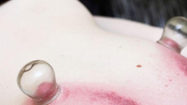 拔罐的好处，拔罐减肥