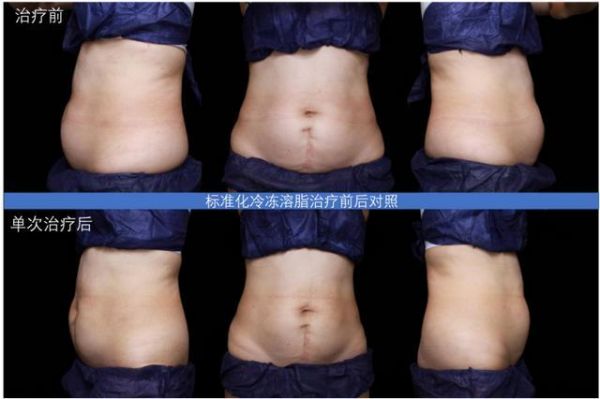 （图3. 标准化冷冻溶脂治疗前后对照，上列为治疗前，下列为单次治疗次后）