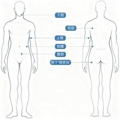 （图2. 冷冻溶脂治疗适宜部位）