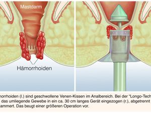 青草药膏可以治痔疮吗