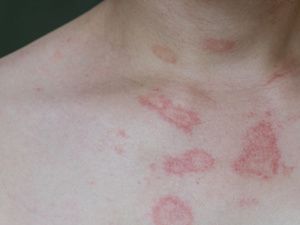 有没有治湿疹的草药膏啊