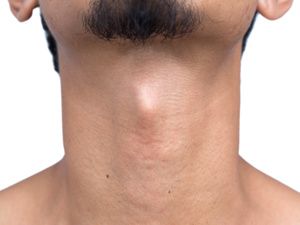 医学百科：北京华坛中西医结合医院专业治疗甲亢、甲减、甲状腺结节、甲状腺炎“医师专访”北京华坛甲状腺科裴海旭主任解答：女性为什么更容易得甲状腺疾病？