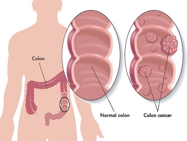 肠癌晚期变精神病