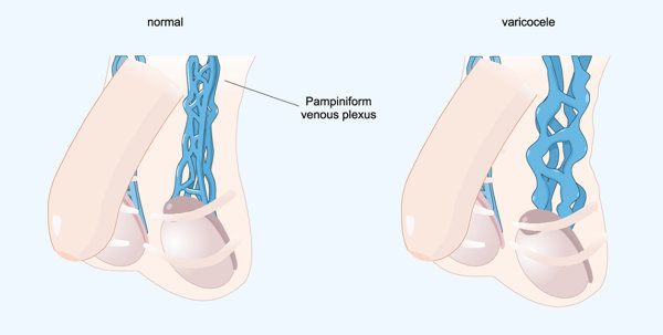 精索静脉曲张刺激直肠