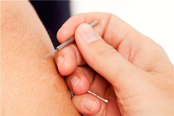 针灸疗程间隔时间是多少