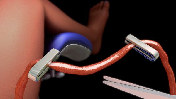 夾腿綜合癥的得強迫癥