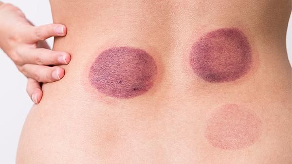 拔罐多久一次合適拔多了對身體傷害