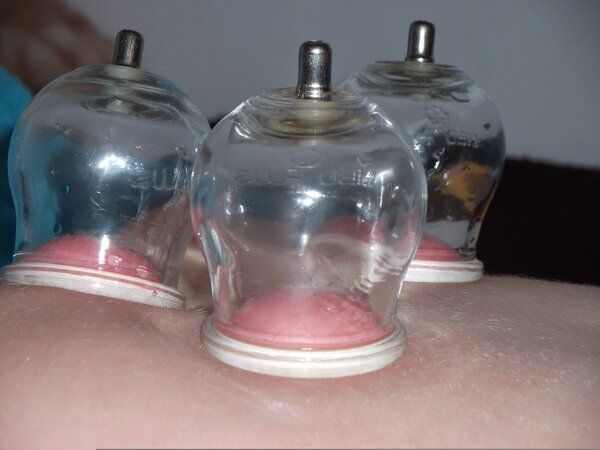 拔罐減肥多長時間一次