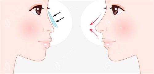 假体隆鼻前后对比