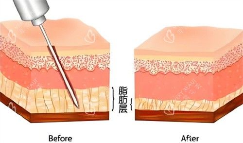 吸脂手术脂肪层对比