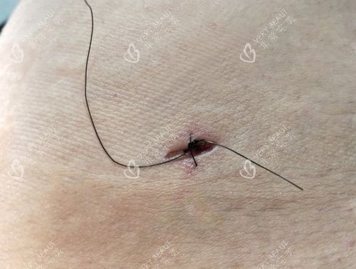 吸脂手术真是伤口