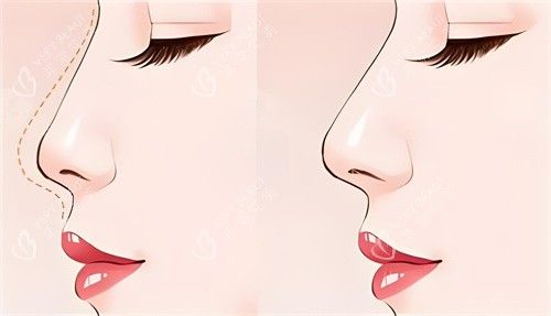 隆鼻前后對比動畫圖