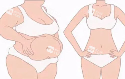 全身吸脂前后对比示意图