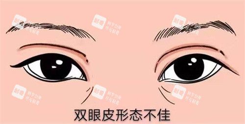 修复双眼皮