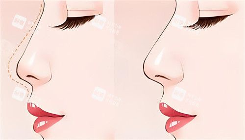 隆鼻前后对比动画图