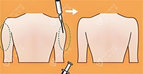 手臂吸脂前后对比