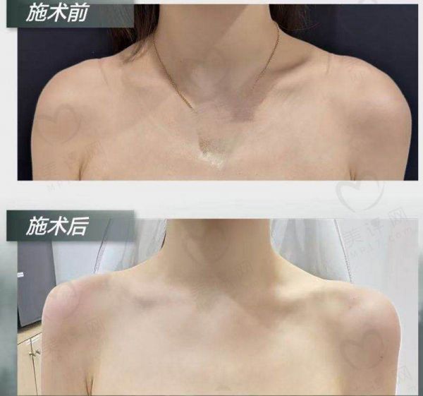 重庆松山医院徐铎医生吸脂技术八大优势解析