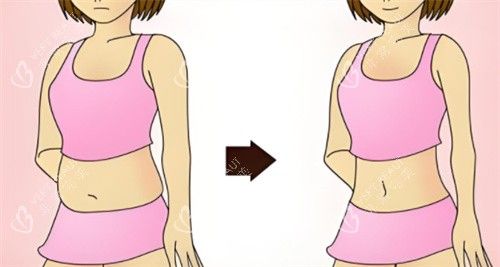 吸脂前与吸脂后对比素材图