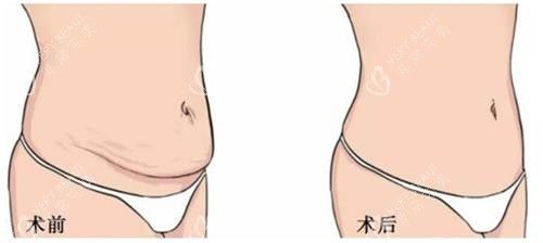 美人鱼腹壁成形手术前后的区别