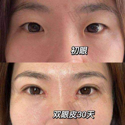 眼部整形价格:从基础双眼皮到网红眼综合,4000元起打造灵动电眼