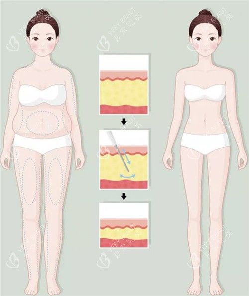 吸脂前后动画图示