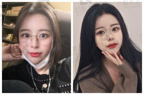 深圳曹孟君腹部吸脂塑形的独特体验