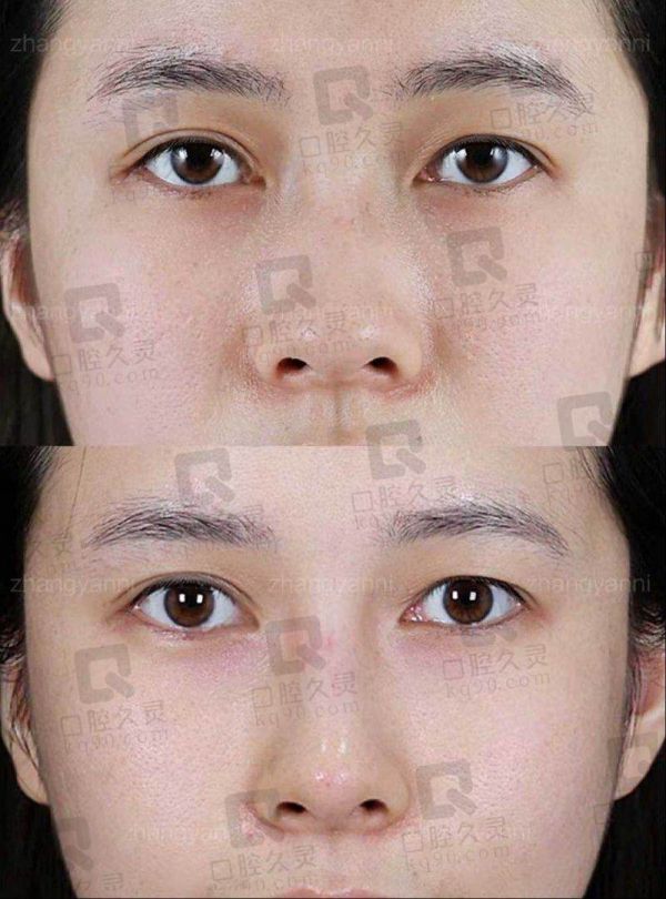 深圳曹孟君腹部吸脂塑形的价格与预约